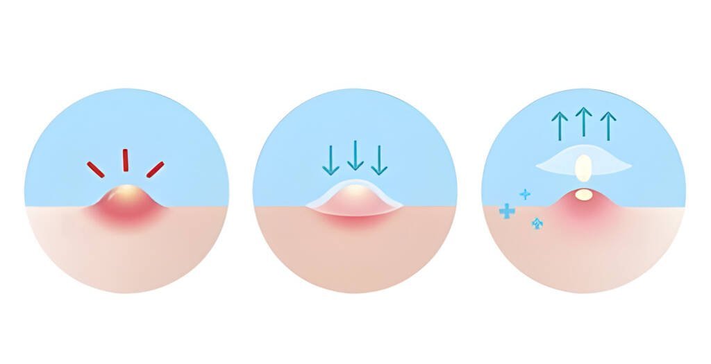 Hydrocolloid Pimple Patches 