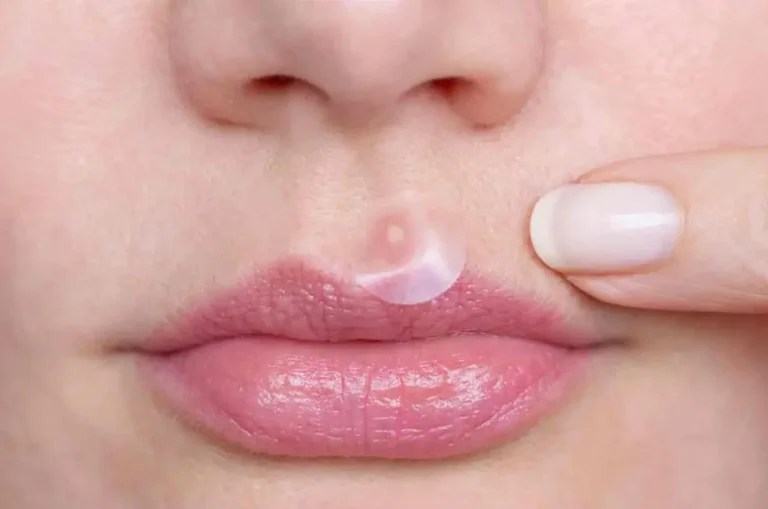 How to Get Rid of Pimple on Lip Top Tips and Treatments